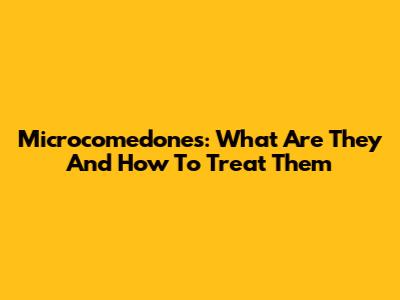 Microcomedones: What Are They And How To Treat Them